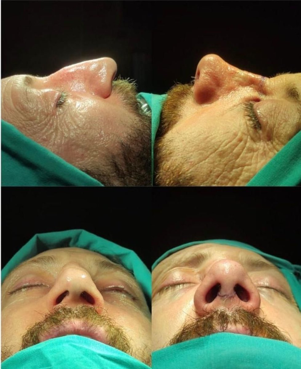 نتائج تجميل الأنف للرجال قبل وبعد في مستشفى ميموريال أنطاليا، تحسين شكل الأنف