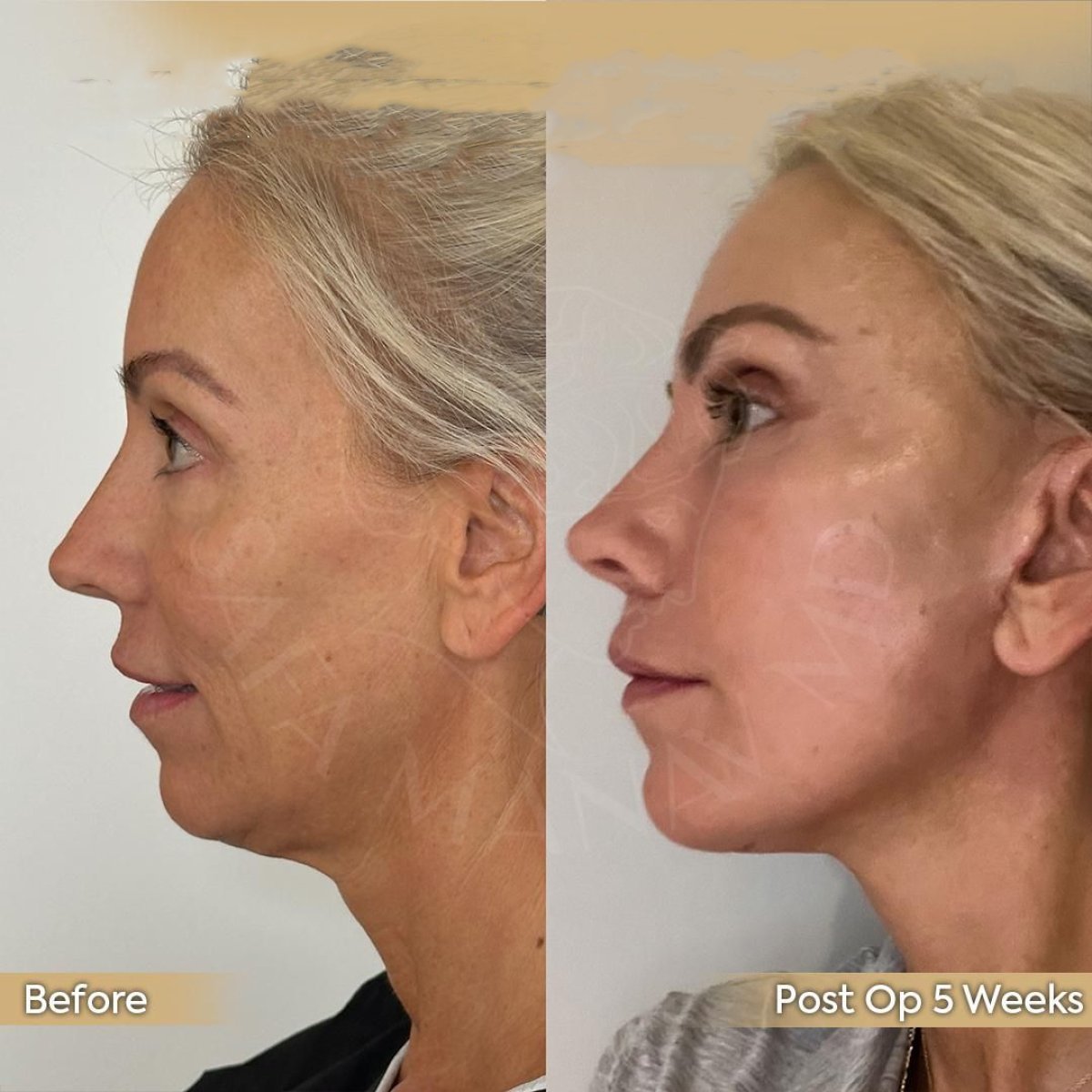 Before and after brow lift results at Dr. Safa Manav Clinic, visible facial rejuvenation