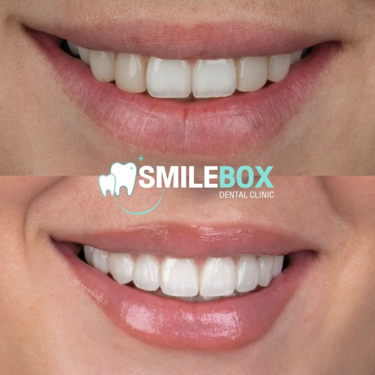 نتائج قبل وبعد ترابط الأسنان في SmileBox Dental Clinic - Thonglor, Sukhumvit Branch