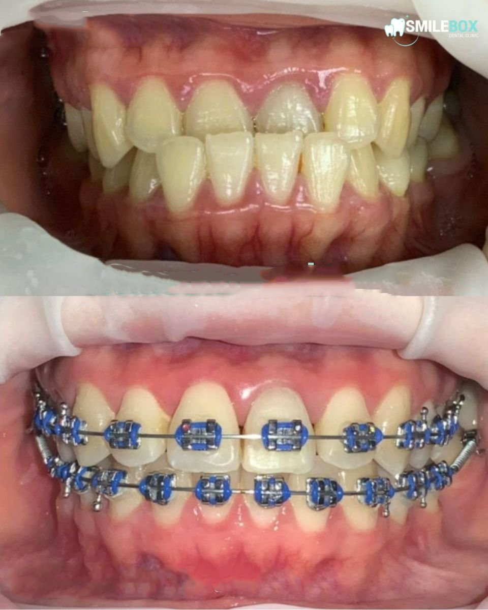 Before and after braces treatment at SmileBox Dental Clinic - Thonglor, Sukhumvit Branch results