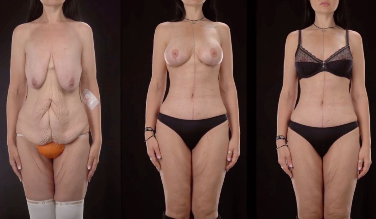 Результаты до и после абдоминопластики в Yurchenko Plastic Surgery Team Kyiv, контур тела