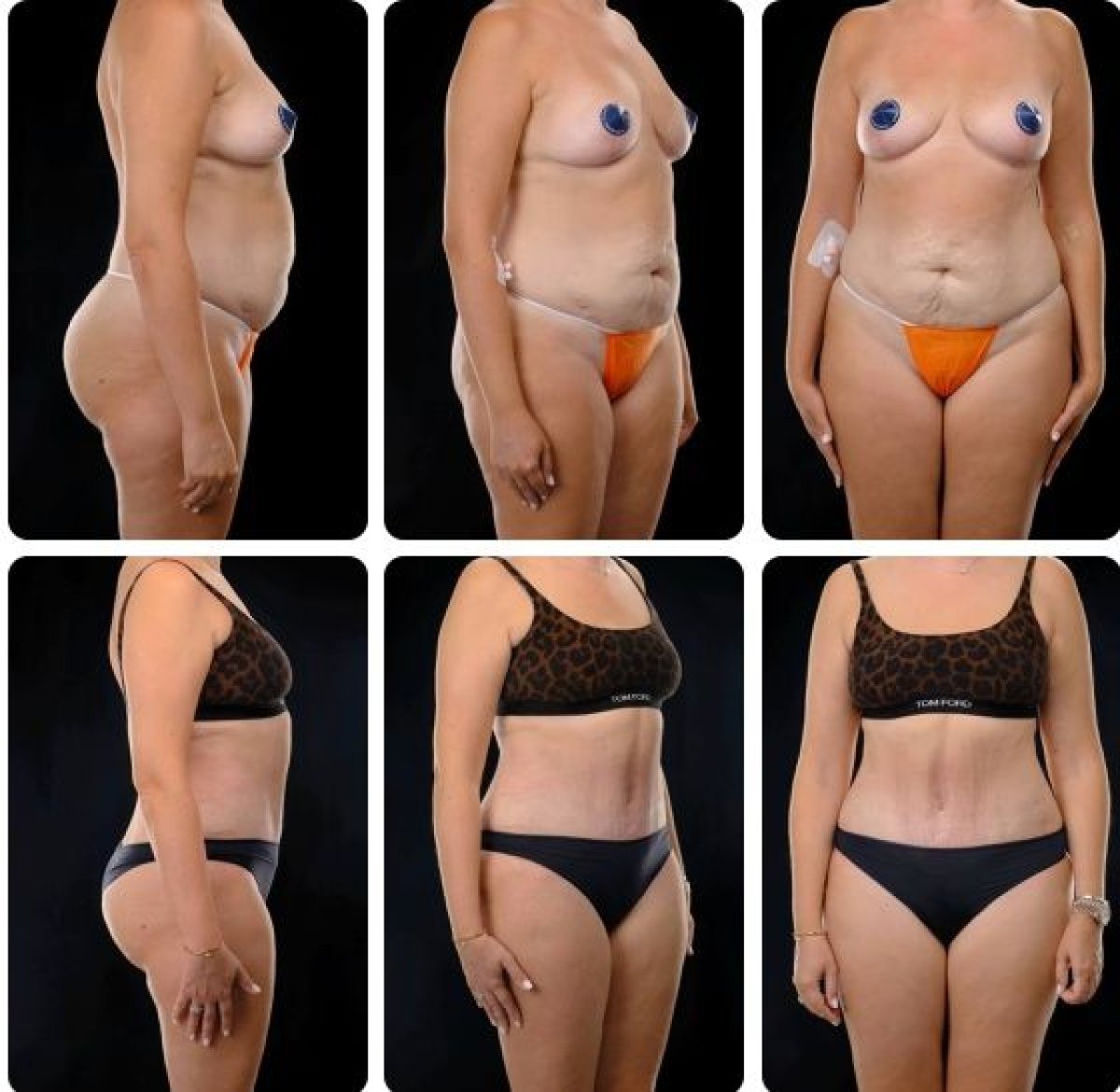Результати до і після абдомінопластики в Yurchenko Plastic Surgery Team Kyiv, покращений контур живота