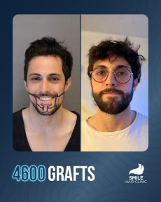 All-Inclusive Beard Transplantation (Platinum Package)