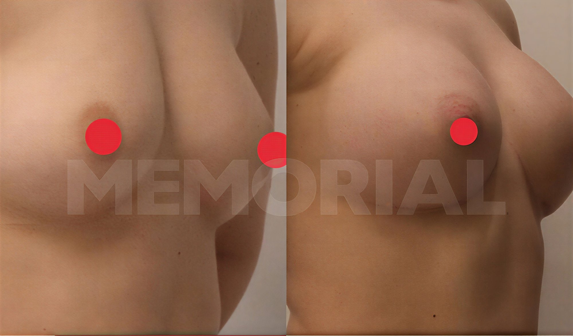 Antes y después de implantes mamarios con lifting en Memorial Ataşehir Hospital, mejor forma