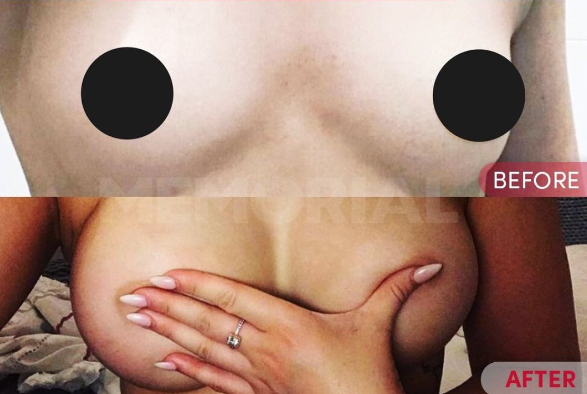 Resultados antes y después de implantes y levantamiento de senos en Memorial Ataşehir Hospital
