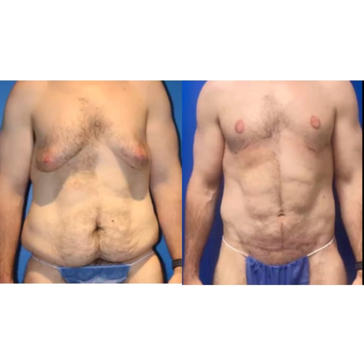 Resultados de liposucción antes y después en Cairo Plastic Clinic, mejor contorno masculino