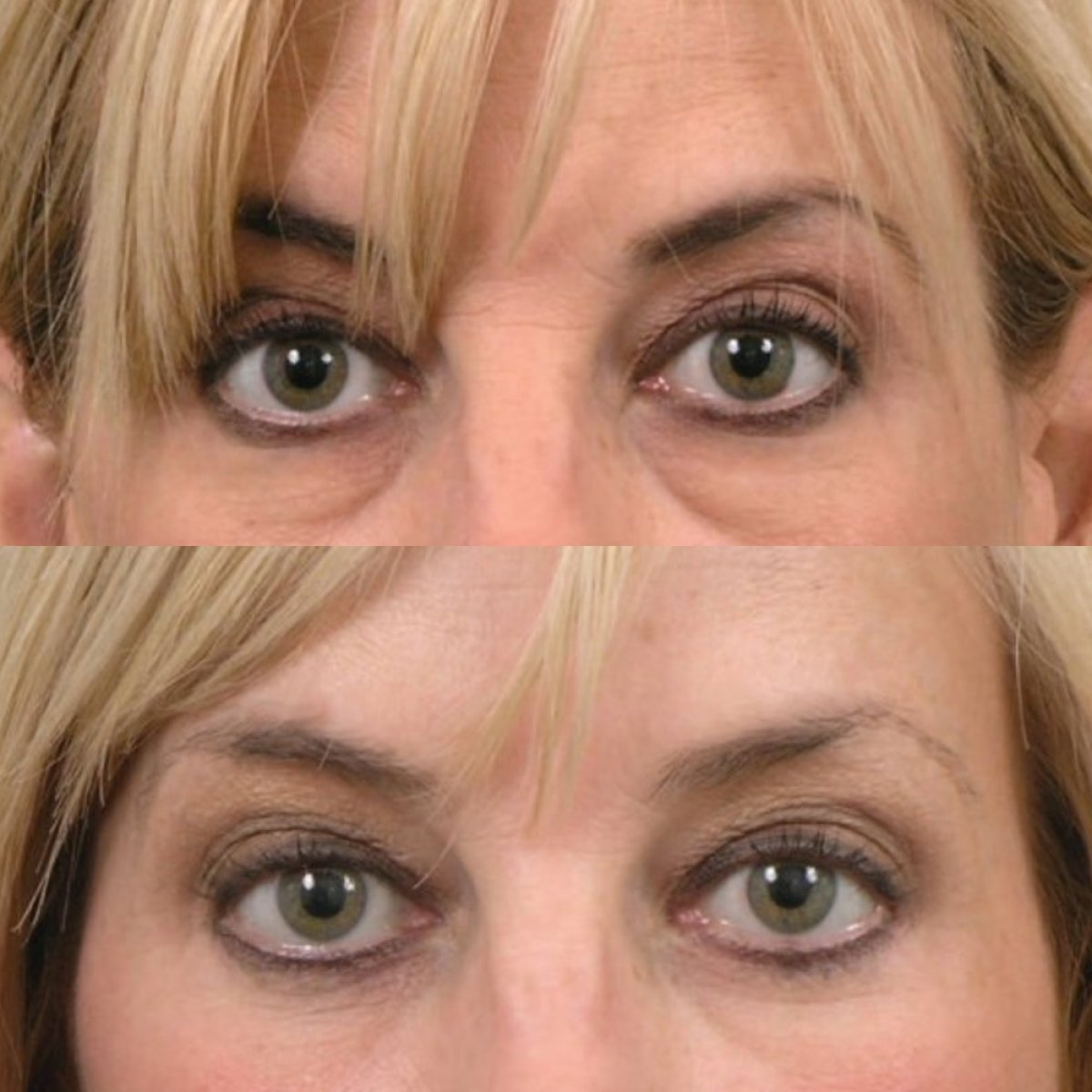 Résultats avant et après blépharoplastie à Cairo Plastic Clinic, correction des paupières