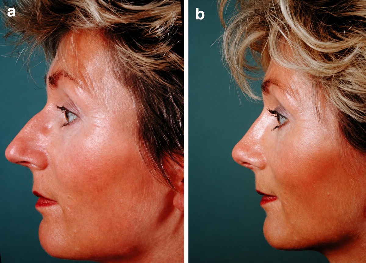 Before and after rhinoplasty results at Cairo Plastic Clinic, improved nose shape and profile