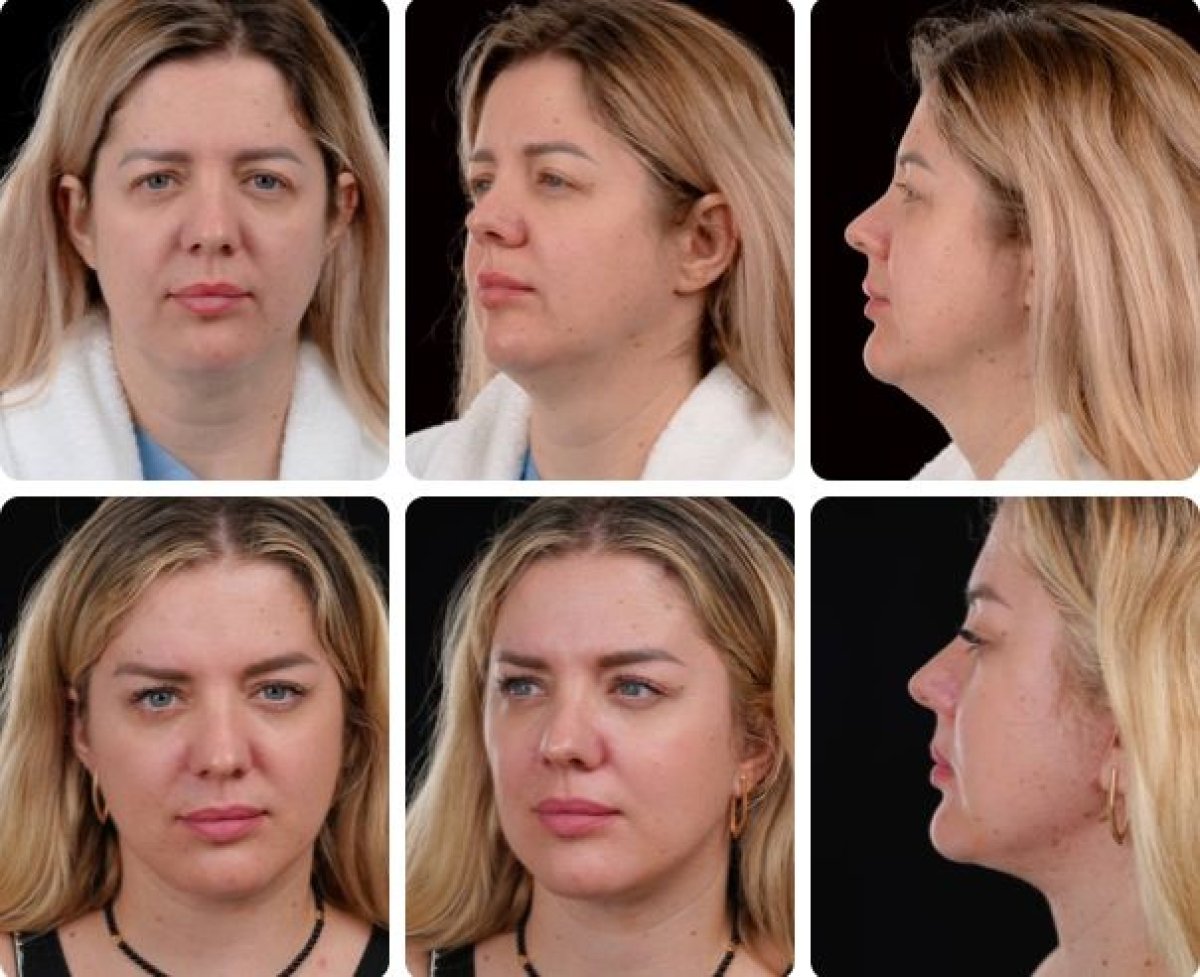 Результати до і після фейсліфтингу в Yurchenko Plastic Surgery Team, омолодження обличчя