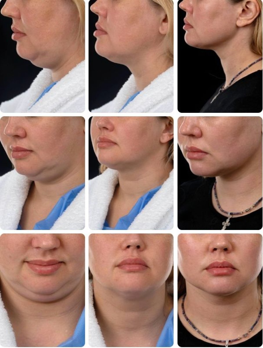 نتائج شد الوجه قبل وبعد في Yurchenko Plastic Surgery Team، تحديد الفك بوضوح