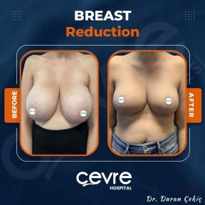 Breast Reduction surgery - photo 4