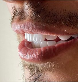 E-Max Veneer - Hollywood Smile