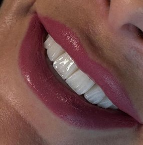 E-Max Veneer - Hollywood Smile - photo 3
