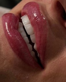 E-Max Veneer - Hollywood Smile - photo 2