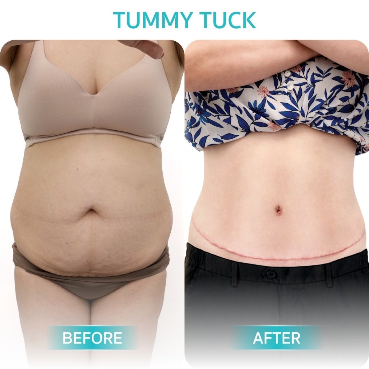Before and after tummy tuck results at Wansiri Hospital – visible abdominal contour improvement