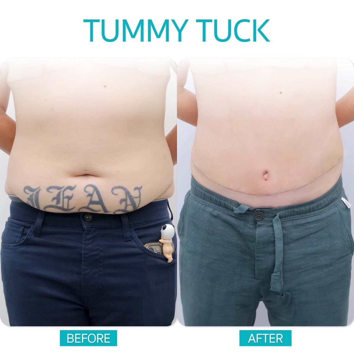 Before and after tummy tuck results at Wansiri Hospital – visible abdominal contour improvement
