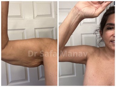 Premium Arm lift (brachioplasty) All Included - photo 2