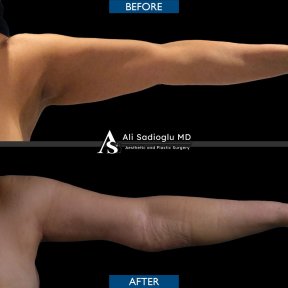 Premium Arm lift (brachioplasty) All Included - photo 6