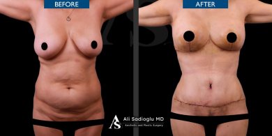 Premium Arm lift (brachioplasty) All Included