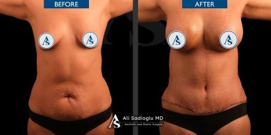 Premium Arm lift (brachioplasty) All Included - photo 2