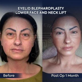Premium Arm lift (brachioplasty) All Included - photo 4