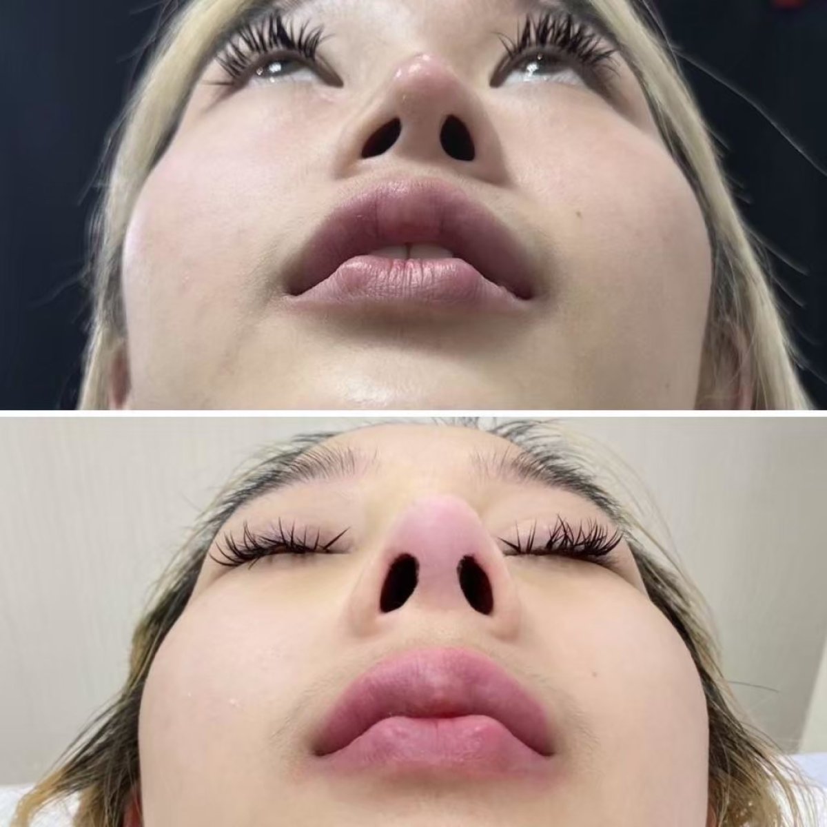 Resultados antes y después de septoplastia en Wansiri Hospital, mejor simetría nasal