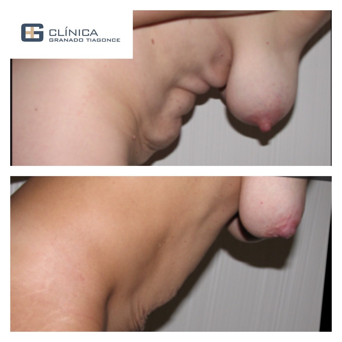 Resultados de abdominoplastia y liposucción antes y después en Clinica Granado Tiagonce, abdomen
