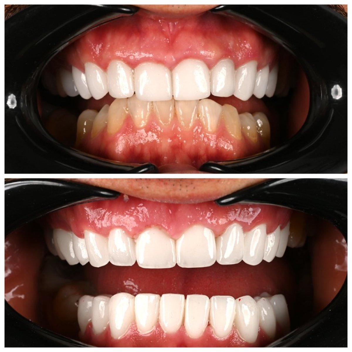 Antes y después de coronas de zirconia en Soraca Med, resultado visible de transformación de sonrisa