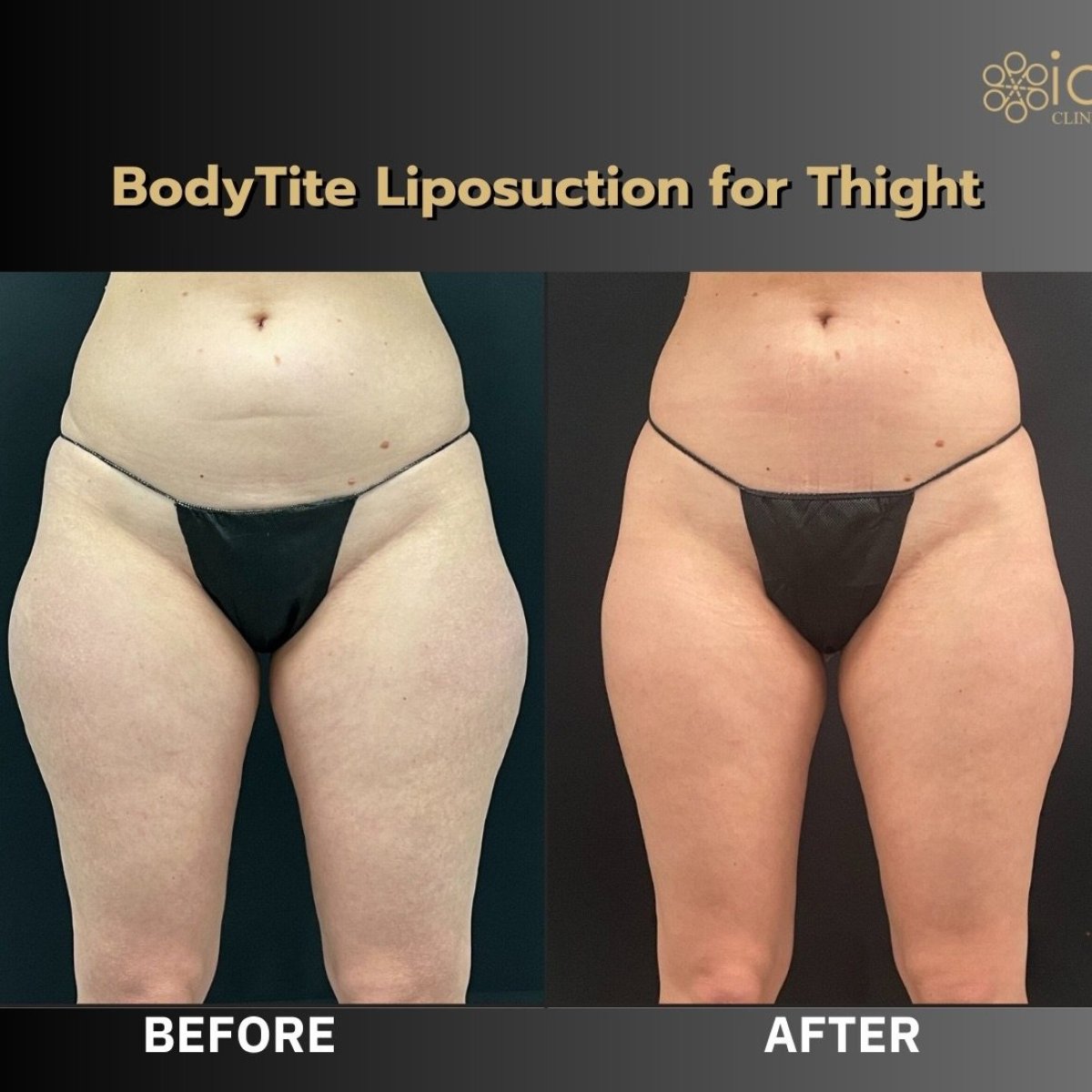 Efekty liposukcji ud BodyTite przed i po w ID Clinic Bangkok, modelowanie sylwetki