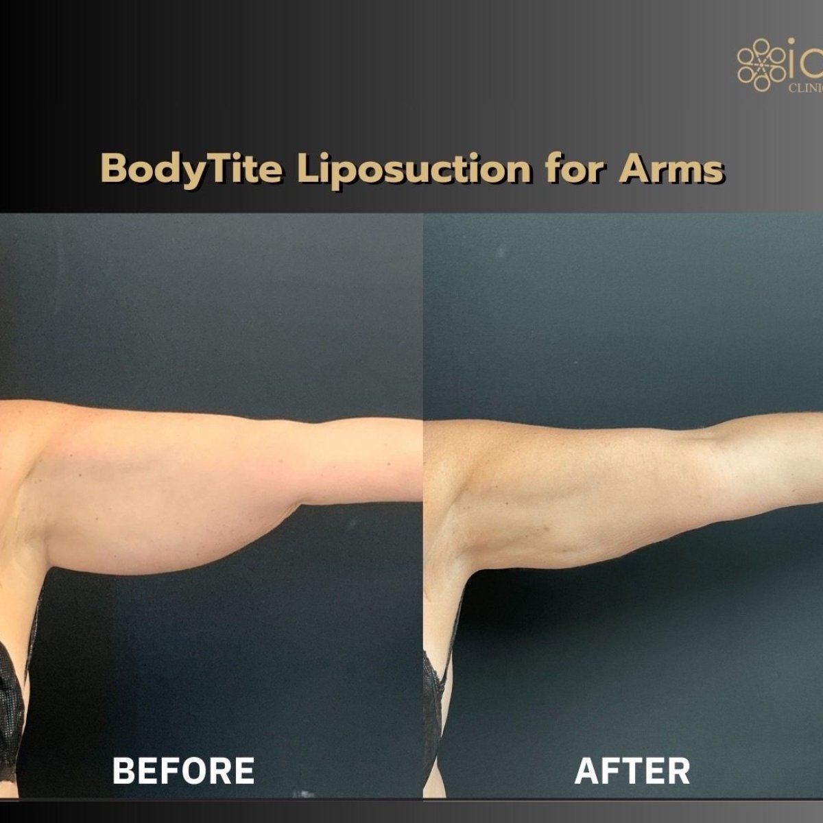 Efekty przed i po liposukcji ramion BodyTite w ID Clinic Bangkok, poprawiony kontur