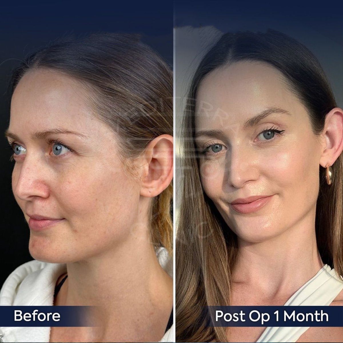 Before and after hooded eyelid surgery results at Dr. Safa Manav Clinic, 1 month post-op