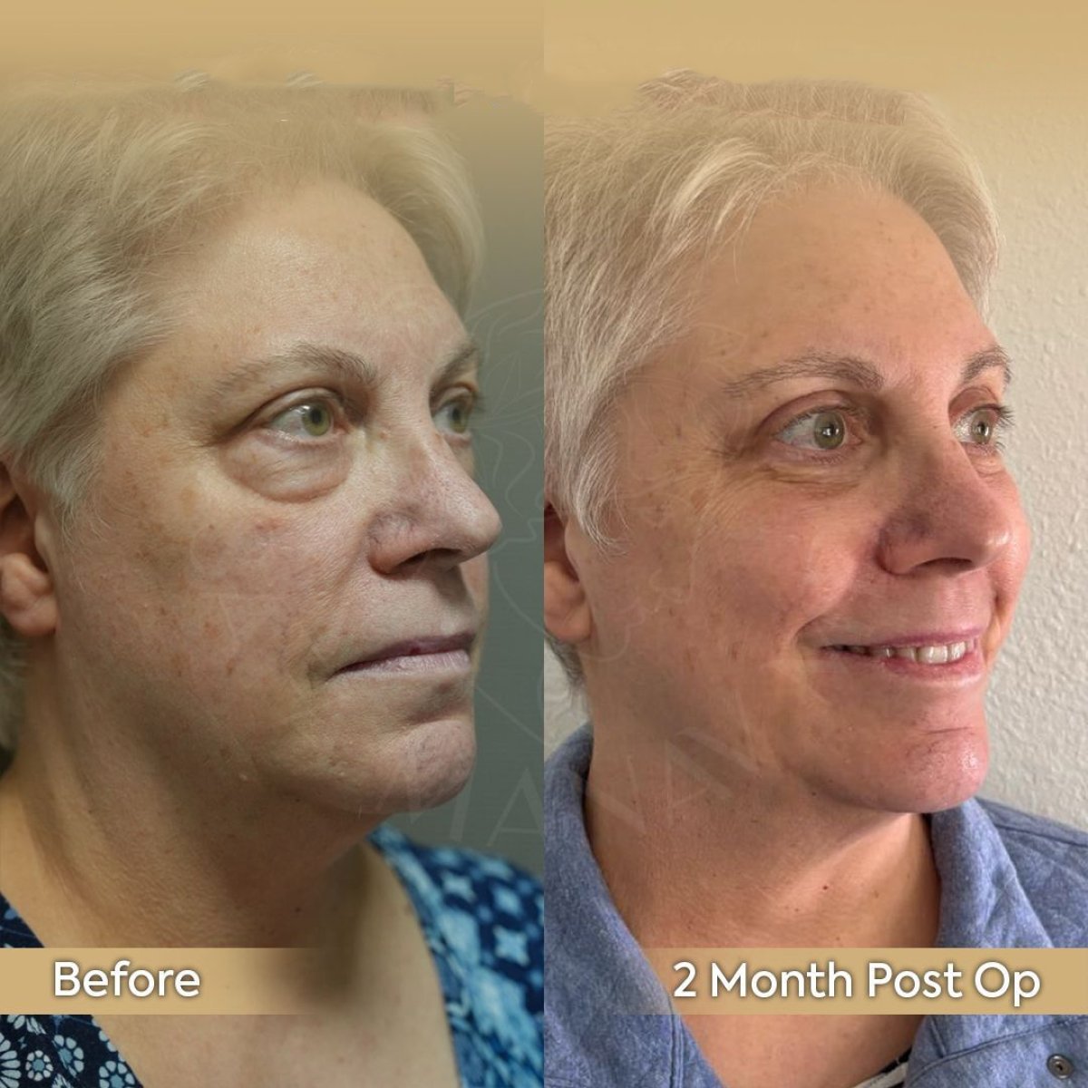 Before and after hooded eyelid surgery results at Dr. Safa Manav Clinic, 2 months post-op