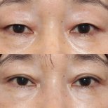 Fotos vor und nach Blepharoplastik (Augenlidkorrektur) durch Dr. Kim Joo Bong 