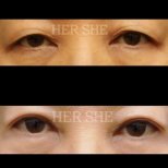 Fotos vor und nach Blepharoplastik (Augenlidkorrektur) durch Dr. Kim Joo Bong 
