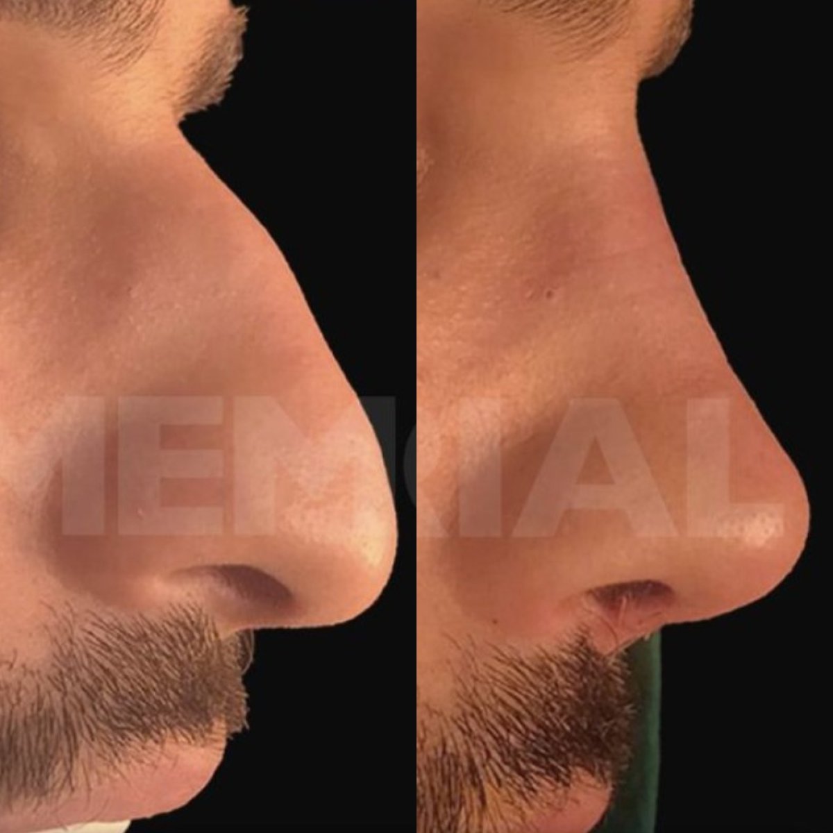 Résultats avant/après rhinoplastie masculine à Memorial Antalya Hospital, profil nasal amélioré
