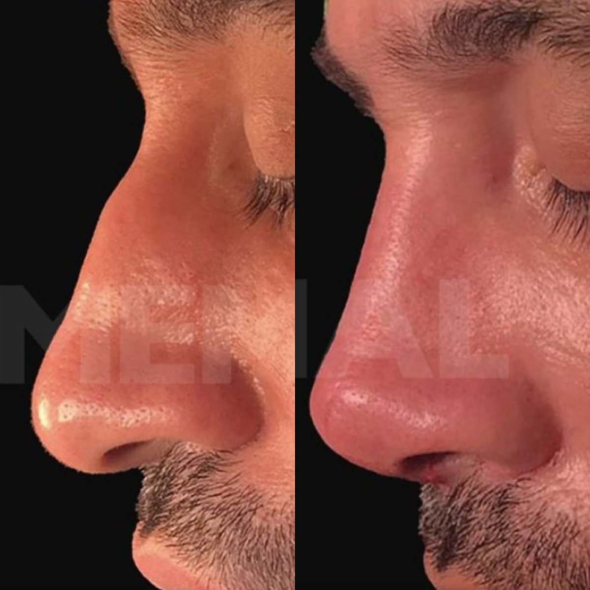Résultats avant/après rhinoplastie masculine à Memorial Antalya Hospital, profil du nez amélioré