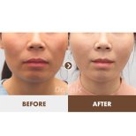Fotos vor und nach Facelift durch Dr. Tak Seung Wan 
