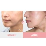 Before and after Facelift photos by Dr. Tak Seung Wan 