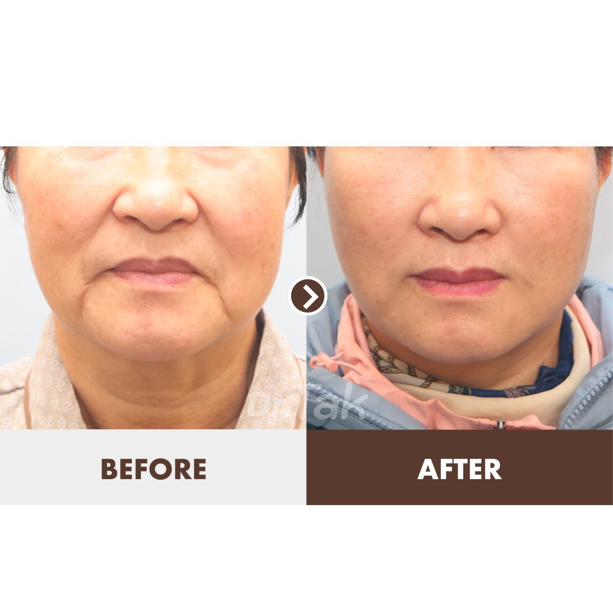 نتائج شد الوجه قبل وبعد في Dr. Tak Plastic Surgery، تجديد واضح للبشرة