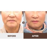 Before and after Facelift photos by Dr. Tak Seung Wan 