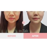 Before and after Facelift photos by Dr. Tak Seung Wan 