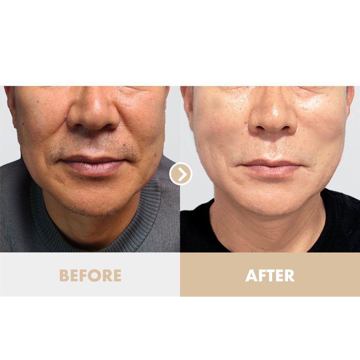 نتائج شد الوجه قبل وبعد في عيادة Dr. Tak Plastic Surgery، تجديد واضح للبشرة
