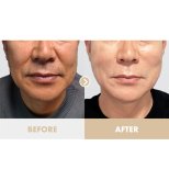 Before and after Facelift photos by Dr. Tak Seung Wan 