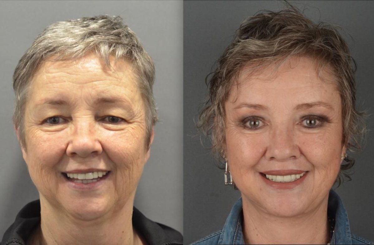 Resultados antes y después de deep plane facelift en Dr. Safa Manav Clinic, rejuvenecimiento facial
