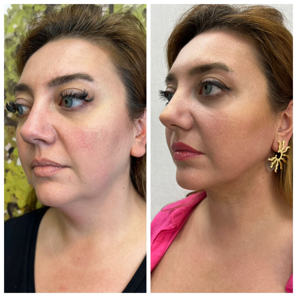 Before and after threads lifting result at CE International Hospital, facial contour improvement