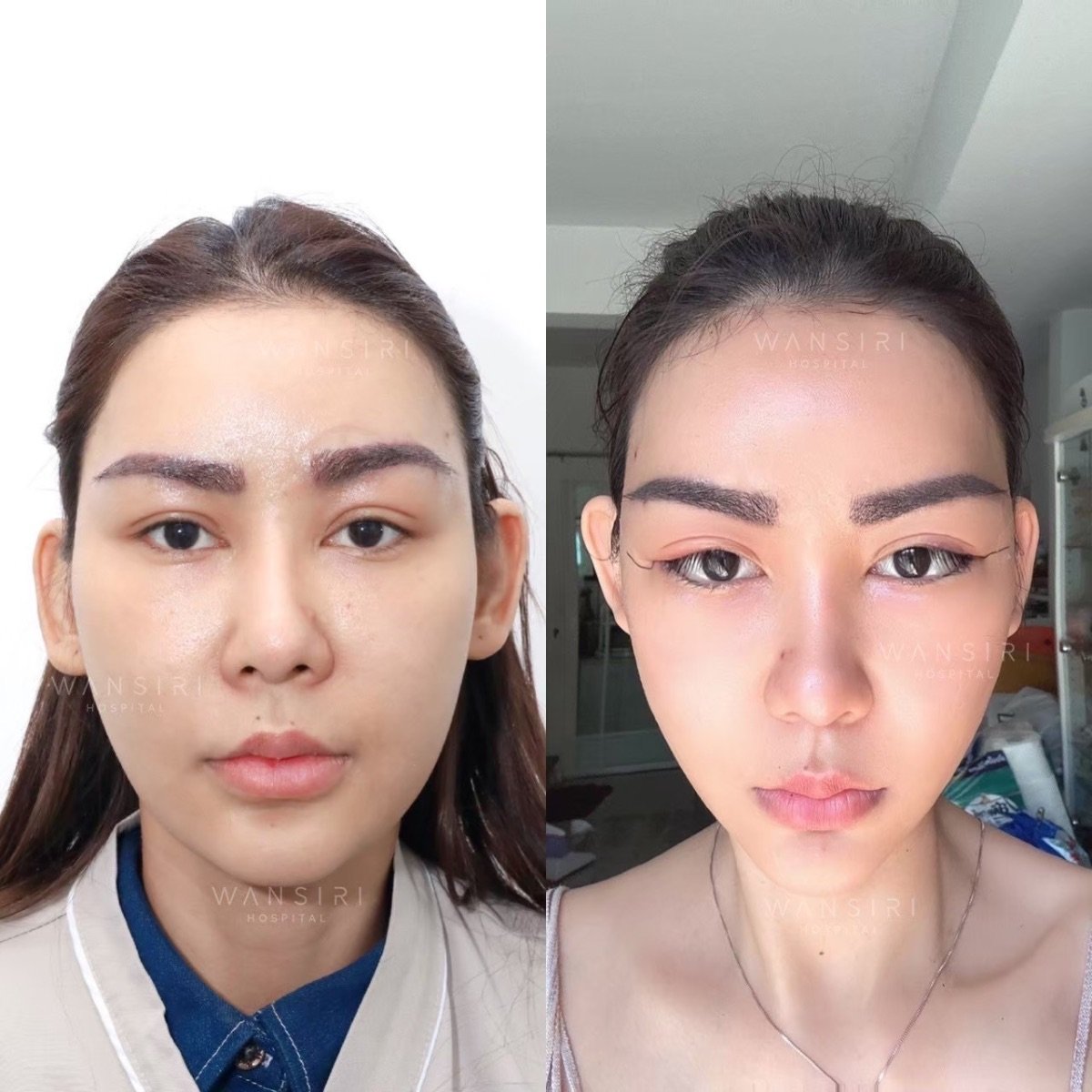 نتائج قبل وبعد Fox Eye Lift في مستشفى وانسيري، مظهر عين مرفوع ومحسن