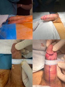 Standard Penis enlargement All Included - photo 6