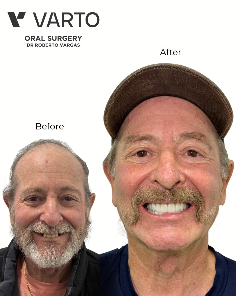 Результат до и после имплантации All-on-4 в Varto Oral Surgery, улучшенная улыбка