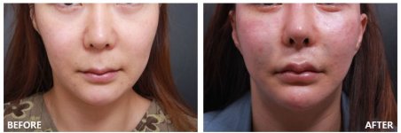Before and after Facelift photos by Dr. Im Young Min