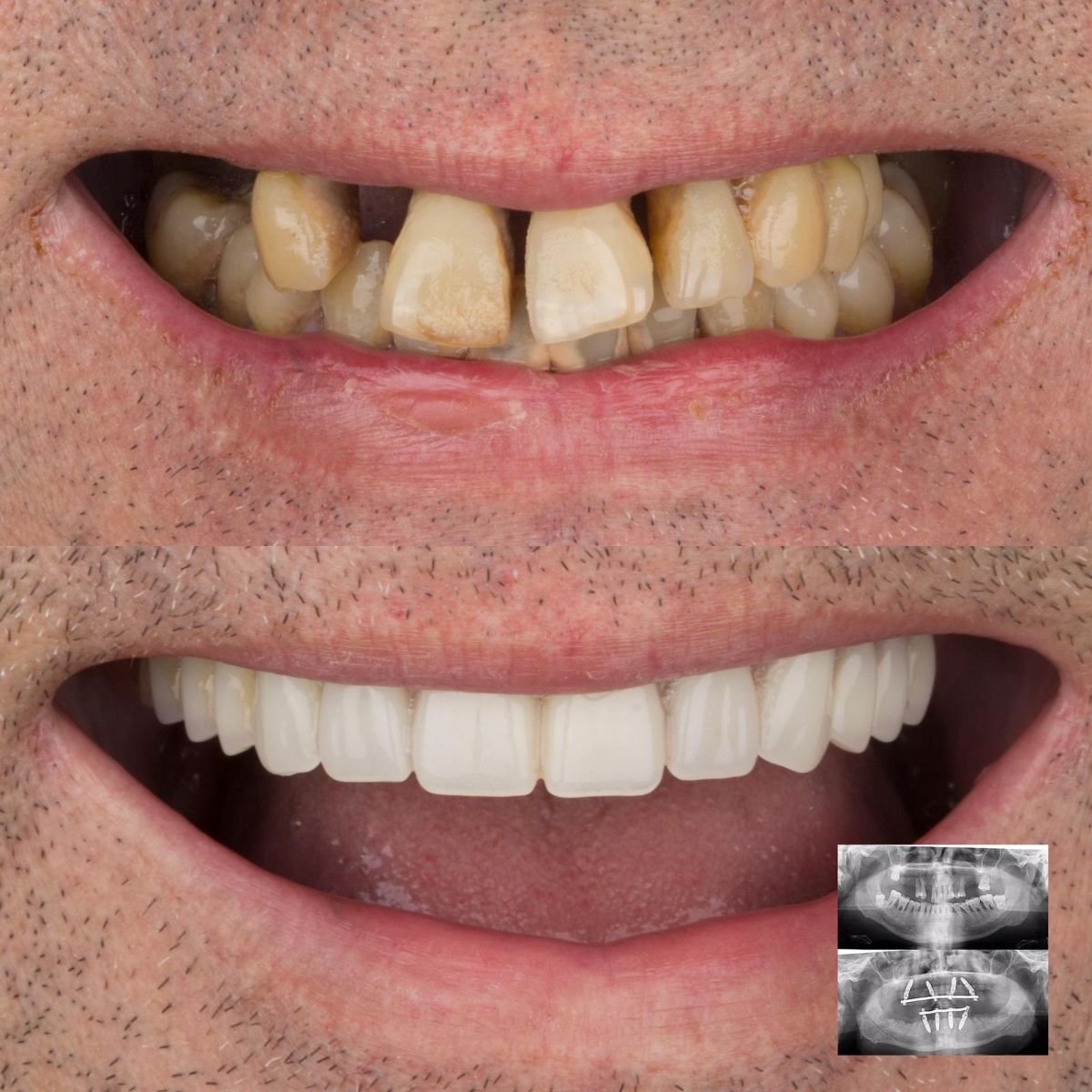 نتيجة زراعة الأسنان All-on-4 قبل وبعد في DENTAGLOBAL Dental Clinic، استعادة الابتسامة